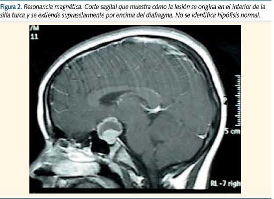 Figura 2. Resonancia magnética. Corte sagital que muestra cómo la lesión se origina en el interior de la
silla turca y se extiende supraselarmente por encima del diafragma. No se identifica hipófisis normal.